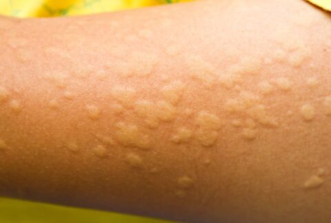 Orticaria cos è cause e sintomi DIABASI