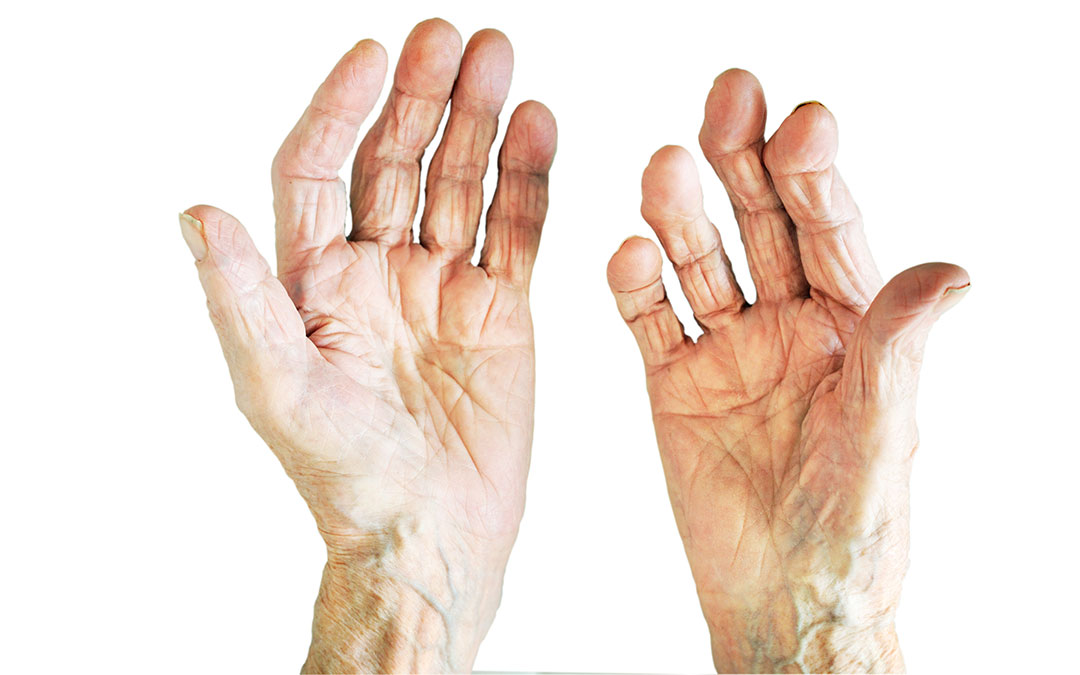 Artrite (reumatoide, artrosi e gotta): sintomi e rimedi